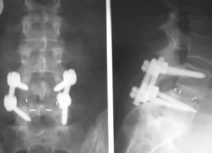 lumbar06 lumbar06