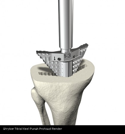 tibial-keel-punch