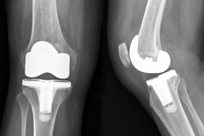 Knee X-ray image after a total knee replacement operation. The diseased knee joint is replaced with artificial material (White parts). Frontal view and side-view.