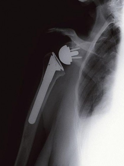 shoulder reversal