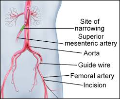 stent3