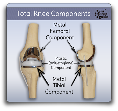 total_knee_replacement_components_model