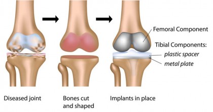 total-knee-replacement-surgery-methods