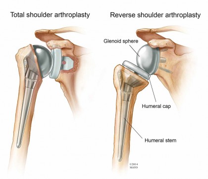 shoulder-arthroplasty-Mayo-Clinic